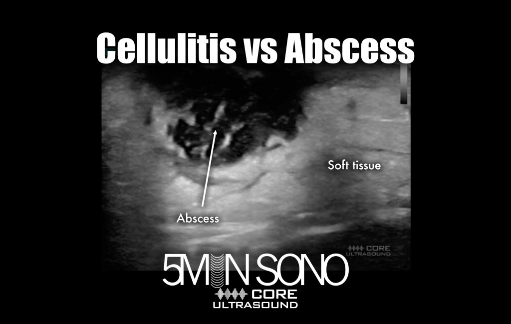Cellulitis vs Abscess Core Ultrasound