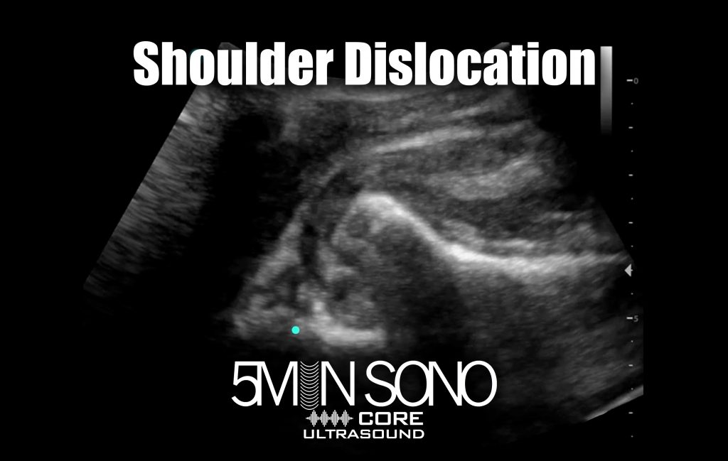 Shoulder Dislocation Core Ultrasound