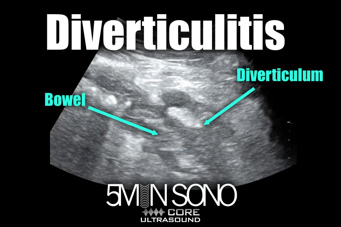 Gastrointestinal core ultrasound