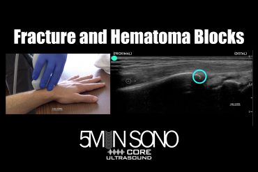 Fracture and Hematoma Blocks Core Ultrasound