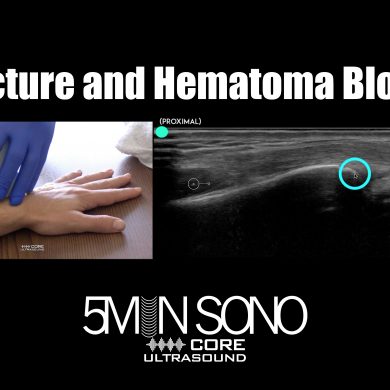 Fracture and Hematoma Blocks Core Ultrasound